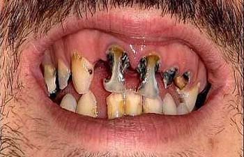 photos really bad teeth